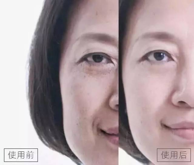 以色列黑科技,1分钟,法令纹,抬头纹消失不见