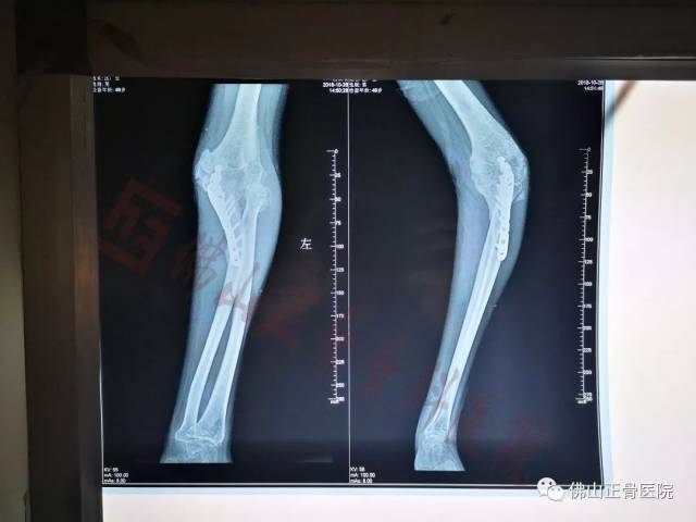 区先生术后x光片
