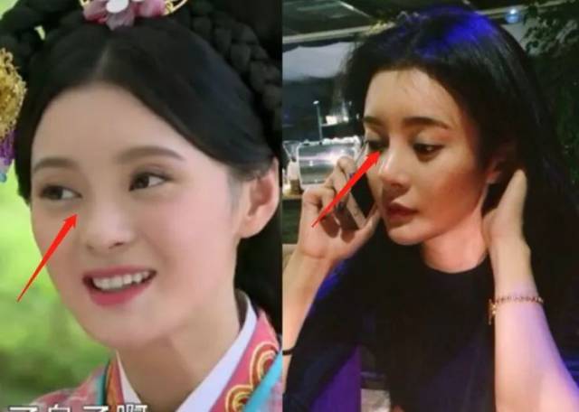连她整形后遗症的朝天鼻也照搬了