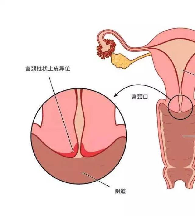 妇科疾病教材中,早在十几年前就移除了这种病,正确的称呼是" 宫颈柱状