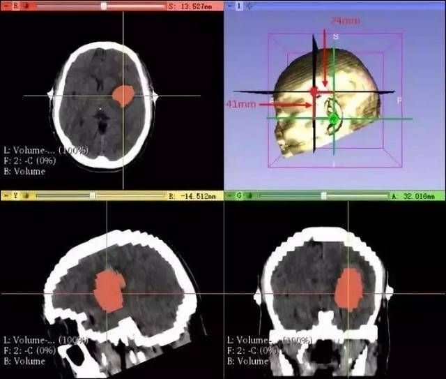 3d-slice重建出颅内血肿及调整头颅为经om线标准位,建立以om线为x线
