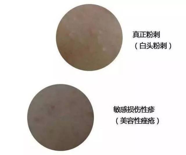 开口闭口粉刺,识别黑头白头.了解这些你冒痘的脸还有得救!