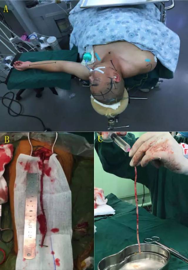 术中场景: a:手术切口及体位;b:取左侧桡动脉长约20cm备用;c:肝素水
