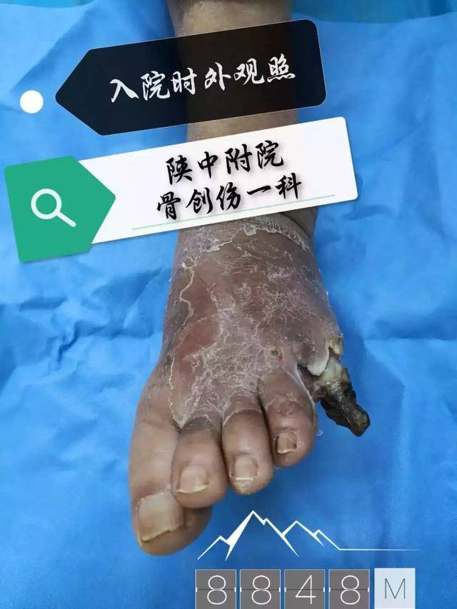 巧施横向骨搬运血运重建术 打破糖尿病足截肢"魔咒"