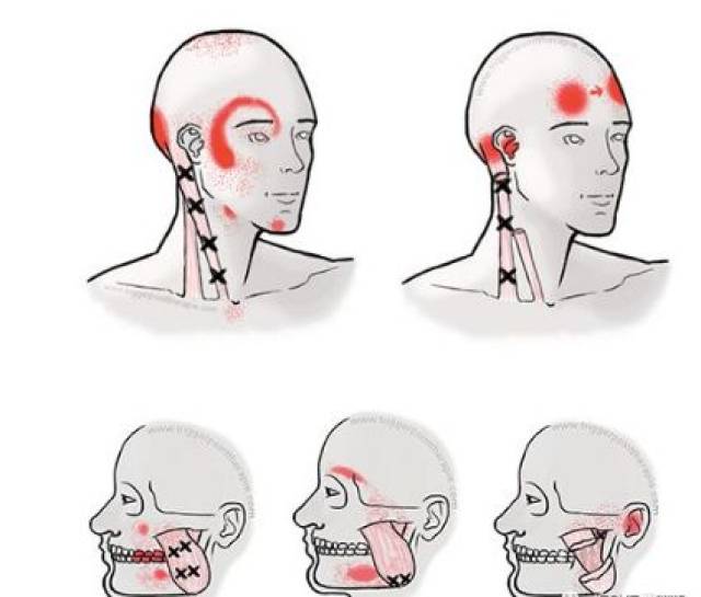 面部疼痛触发点