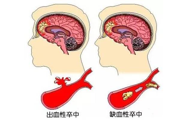 液不能流入大脑而引起脑组织损伤的一种疾病，包括缺血性和出血性卒中。