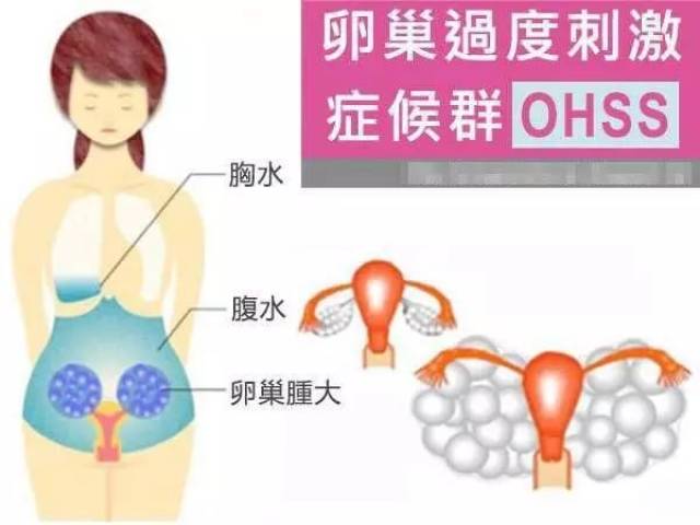 卵巢过度刺激综合征(OHSS)