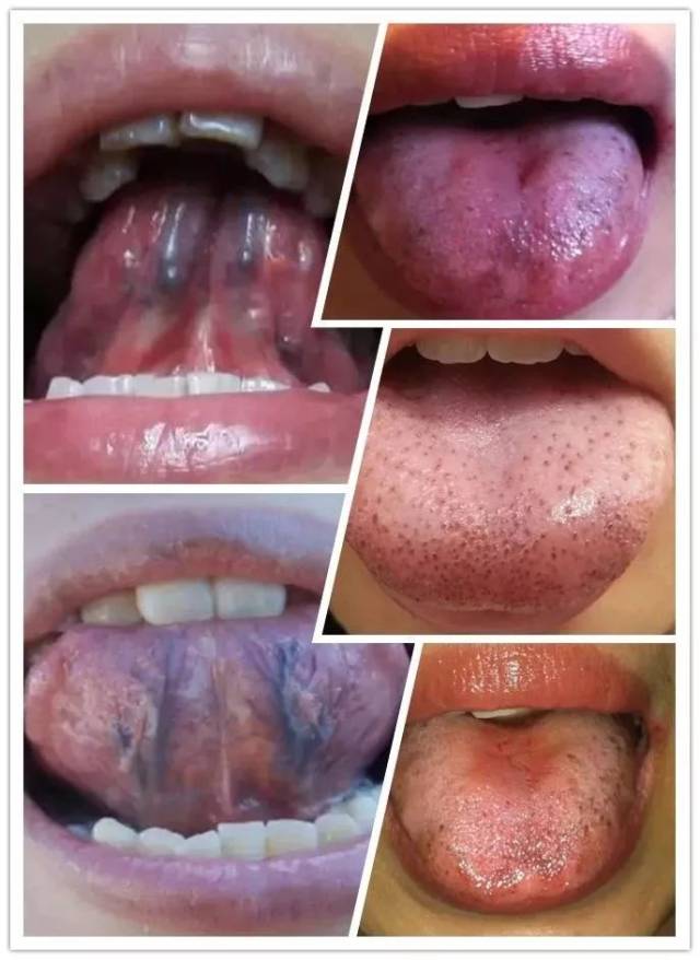 1,舌头的舌边和舌尖,容易出现瘀斑和瘀点.比如这样