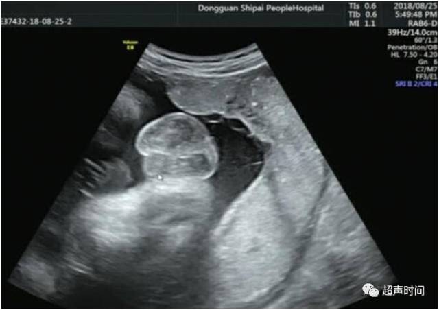 孕 周二维超声示胎儿男性外生殖器,呈「郁金香征」