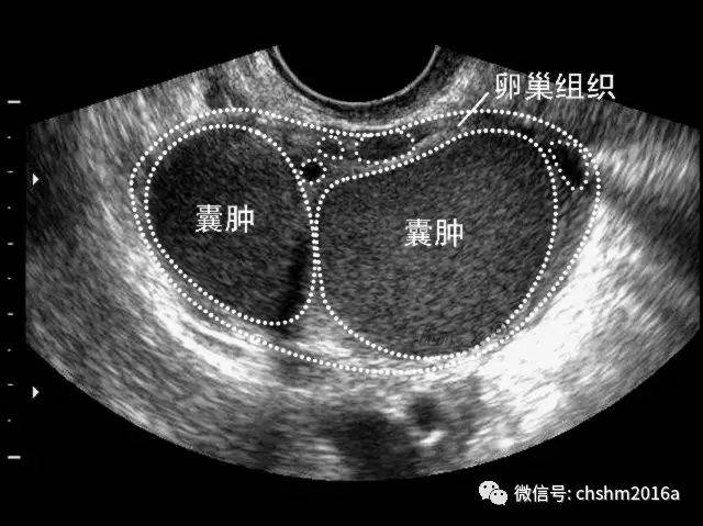 图11-2-31 卵巢巧克力囊肿声像(2)