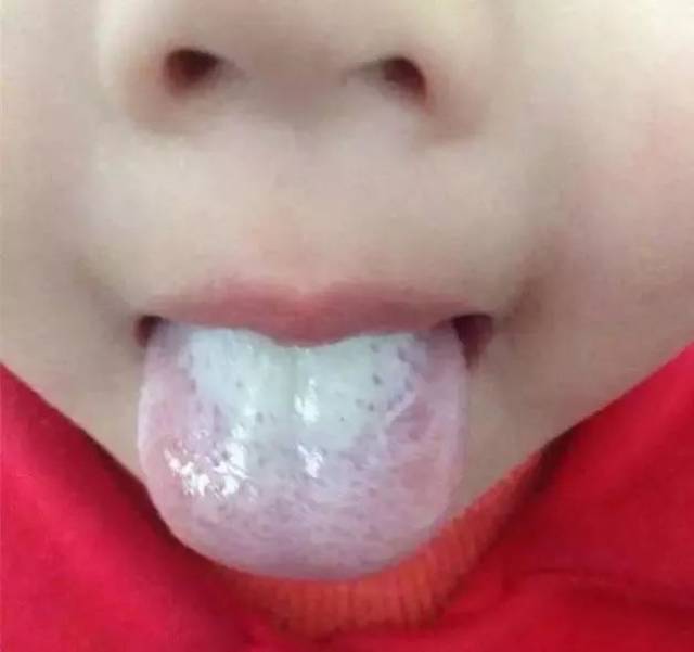 1 舌苔白,厚,腻 舌头上一层厚厚的白色舌苔,这种现象多由中焦脾胃的