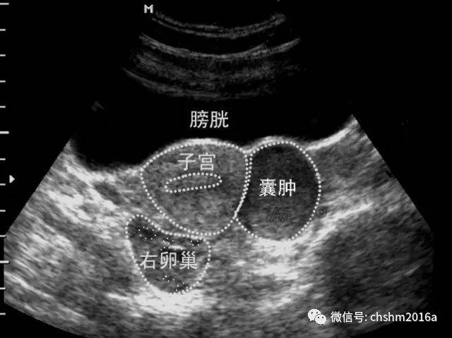 图11-2-30 卵巢巧克力囊肿声像(1)