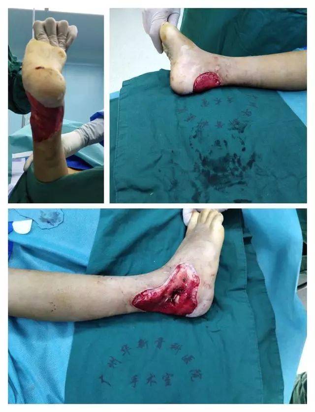 右足踝开放性损伤清创术后病例分享
