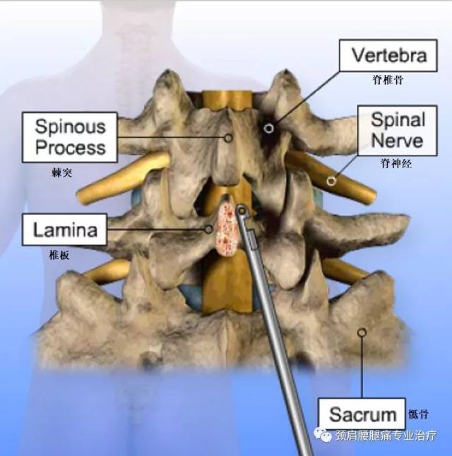 中英文字幕:腰椎椎板切除融合术(lumbar - laminectomy, fusion - un