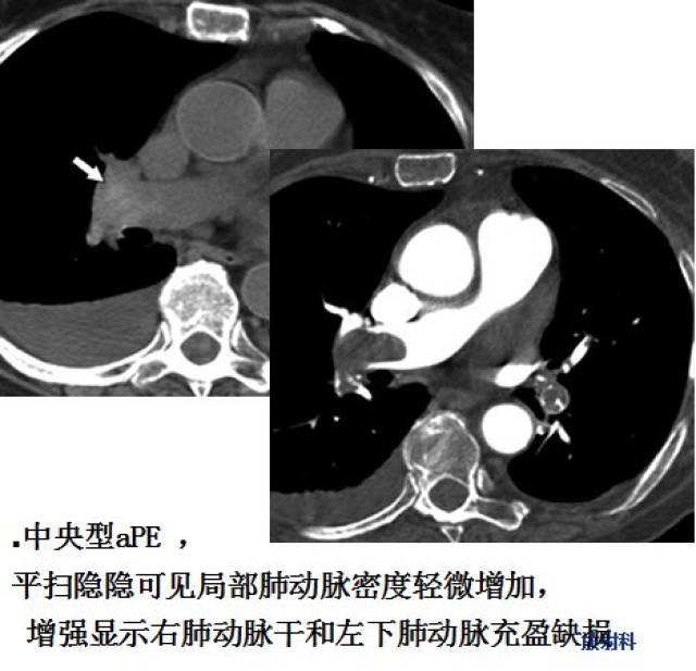 ct平扫与ct增强对比