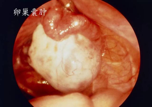 腹腔镜内的卵巢囊肿