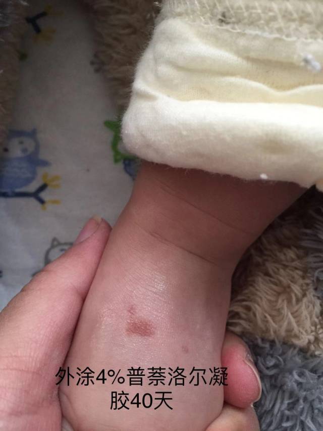 他山之石,可以攻玉,同样的策略非常适合浅表型婴幼儿血管瘤.