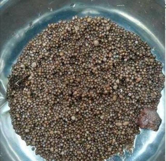 岁长出2980颗肾结石,她的问题很多人都有,再不注意就晚了