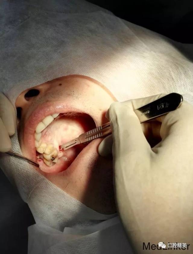 压低磨牙用腭侧种植支抗植入术