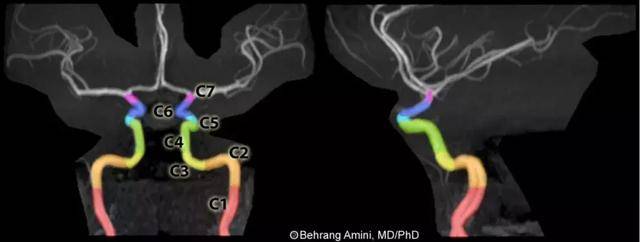 颈内动脉走行分段(1)概述和颈段