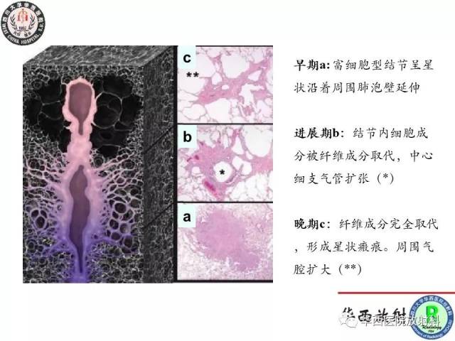 华西放射科病例汇报学习系列之十三--朗格汉斯细胞组织细胞增生症