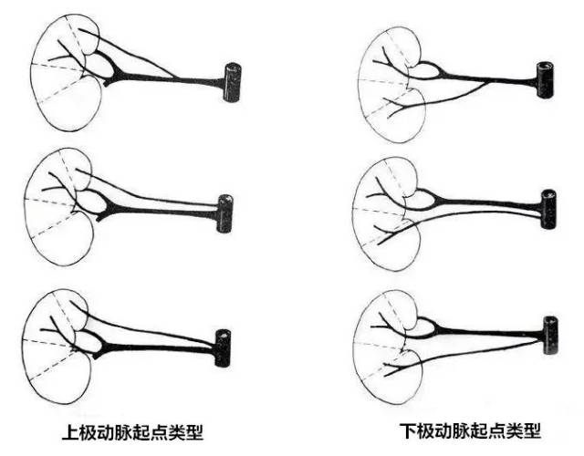 图文详解:肾动脉变异特点