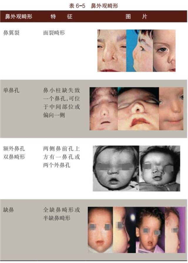 【一文读懂】儿童眼耳鼻发育异常相关疾病