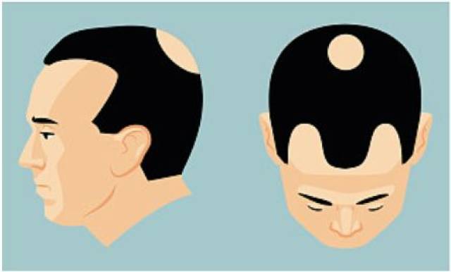 遭遇“鬼剃头”了怎么办？别心塞，这些方法赶