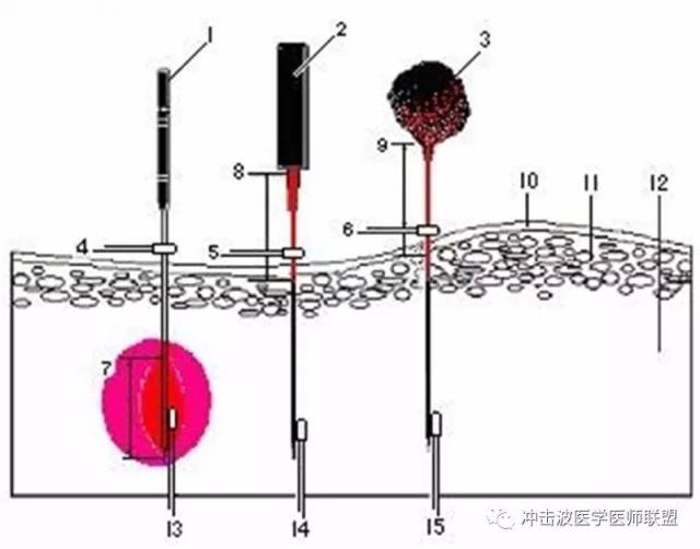 内热针作用的原理内热针技术在中医经络理论指导下,循经选穴,辨证施