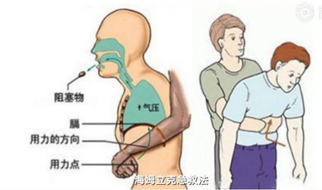 玉林6岁男孩吃花生被呛住窒息身亡,学会海姆立克急救法太重要.