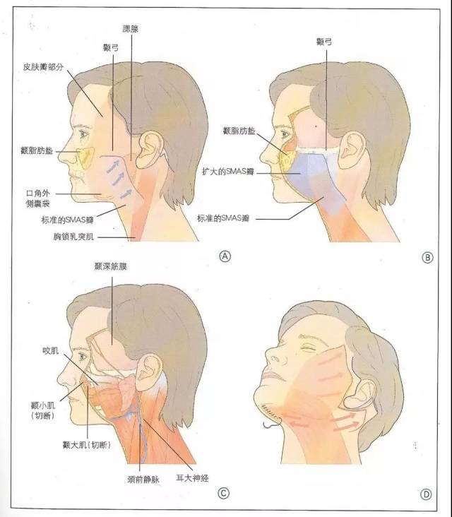 深层提升 将肌肉腱膜层进行提升,对松弛下垂的颧肌,颊脂肪垫,口角囊