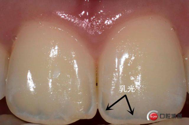 2 不同的牙齿牙釉质的厚度也是不同的.