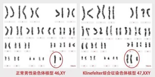 外周血染色体检查提示47,xxy,即克氏综合征