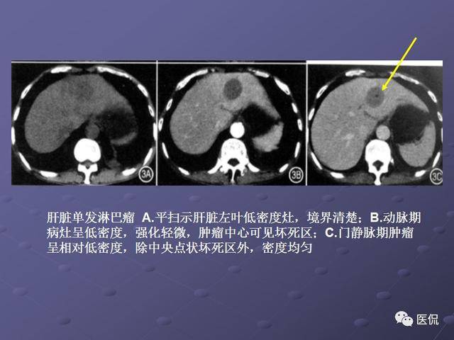 肝脏淋巴瘤动态增强ct的诊断价值 医学影像经典ppt