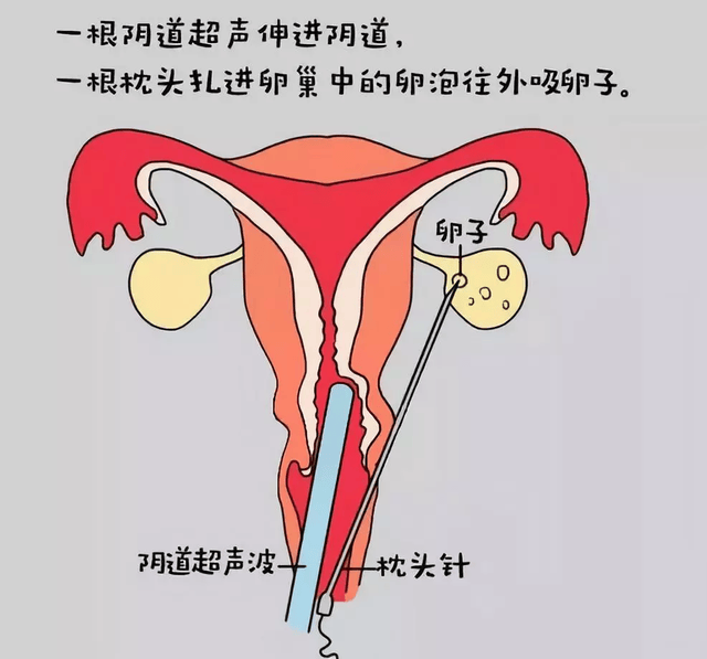 取卵手术一般10-15分钟左右即可完成,通常在