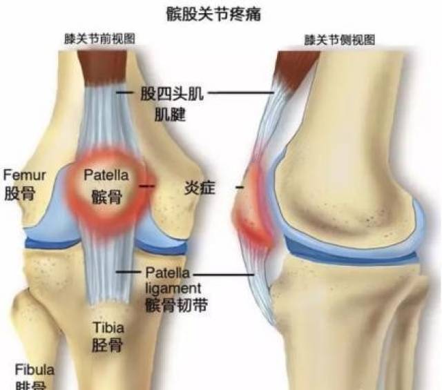 什么是髌骨软化？