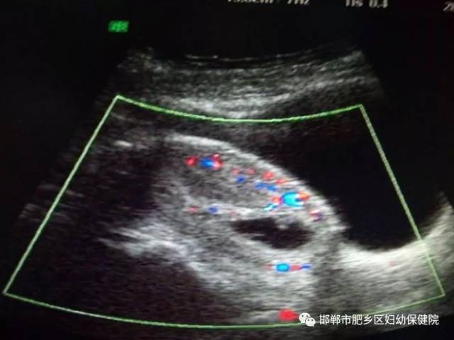 四维彩超确诊子宫瘢痕妊娠一例