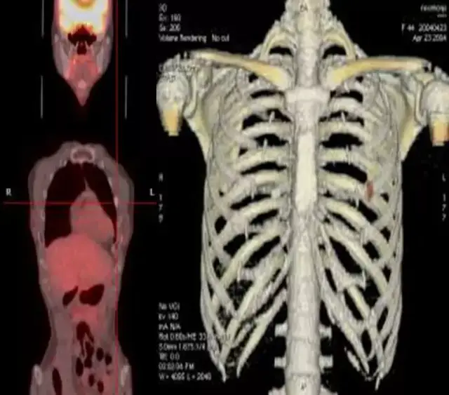 例如,一张正常的ct图,肋骨处看不出什么东西,没有问题;看pet单拍的图