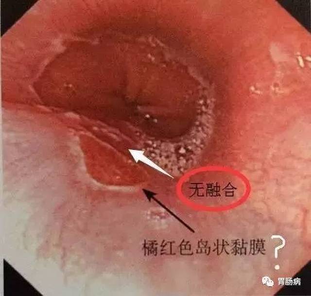 25, 如何诊断barrett食管?