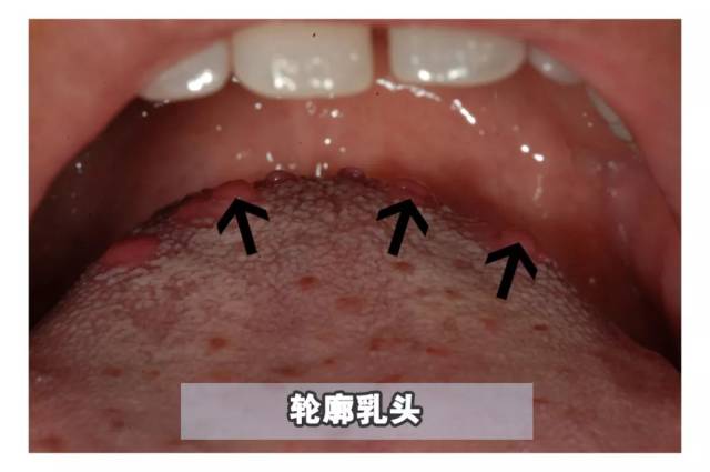 嘴里长了可怕的"肉揪",真的不是口腔癌吗?