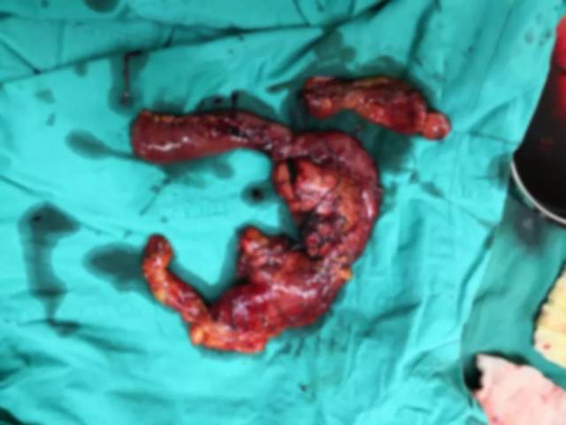 术后标本见胰腺癌侵及胆总管及十二指肠