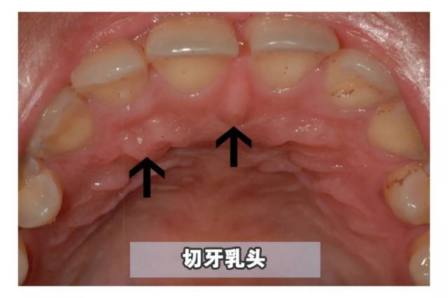 嘴里长了可怕的"肉揪",真的不是口腔癌吗?