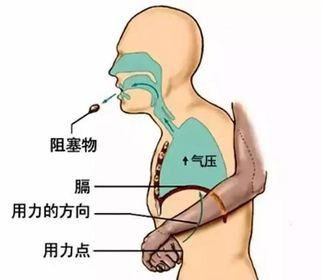 6岁孩童吃花生窒息,母亲无力回天,如果是你怎么救?