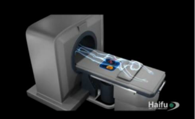 神奇的刀--海扶刀治疗子宫肌瘤后肌瘤消失 (原