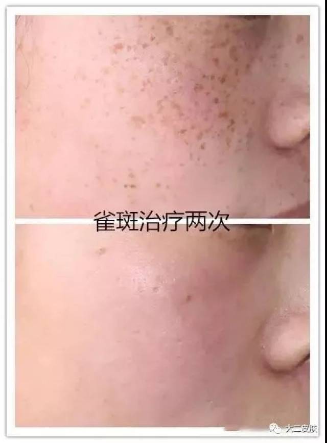 2,色素性疾病:雀斑,太田痣,咖啡斑,颧部褐青色痣,等 3,血管性疾病