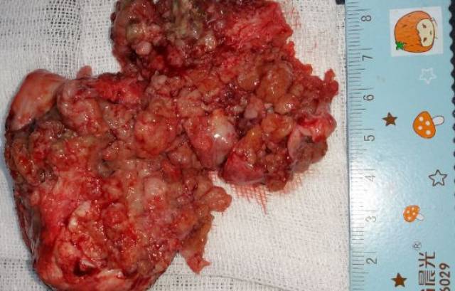 精华病例吐血分享:一例犬耵聍腺瘤