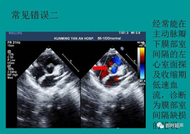 新手常见室间隔缺损误诊分析