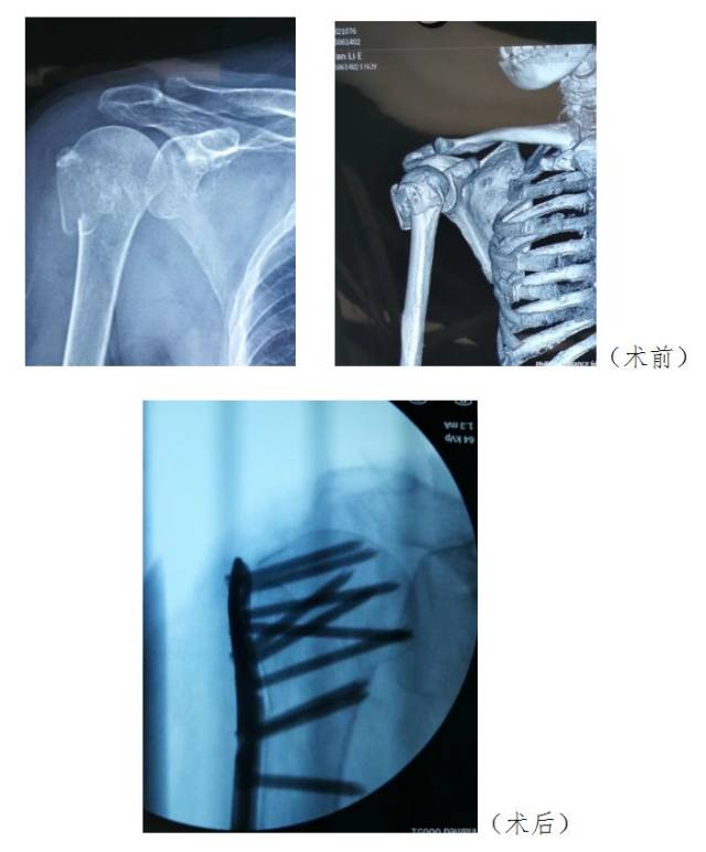 多使用肩手吊带或者石膏悬吊固定制动4-6周,之后视骨折愈合情况进行患