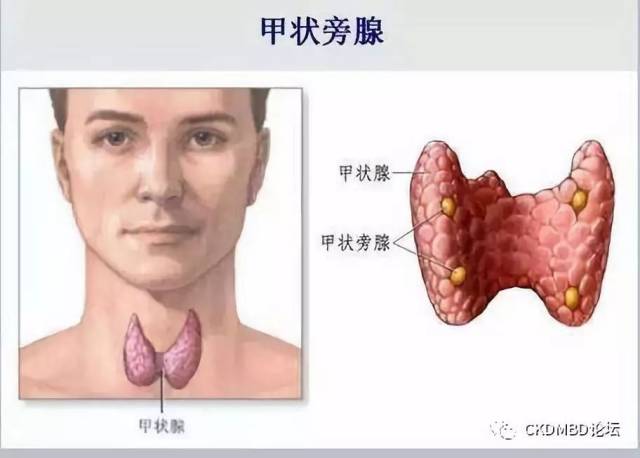 一例尿毒症患者甲状旁腺手术和肾移植的故事