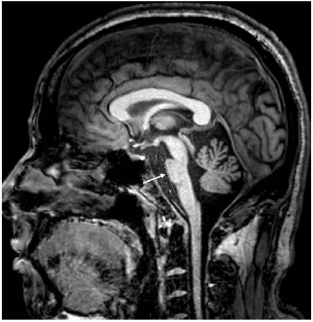 头颅mri t1加权序列矢状位图像显示脊髓小脑性共济失调2型相关的小脑